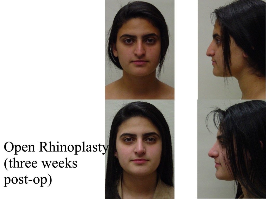 rhinoplasty surgeons Kendall Jenner's Complete Beauty Evolution
